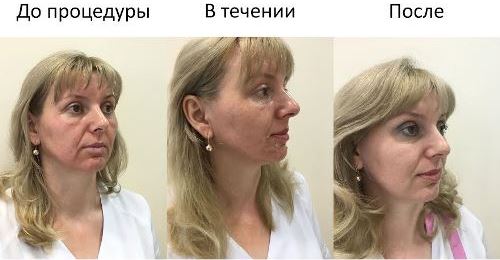 натуральные пилинги, косметология в Иркутске, лечение акне, антивозрастные пилинги