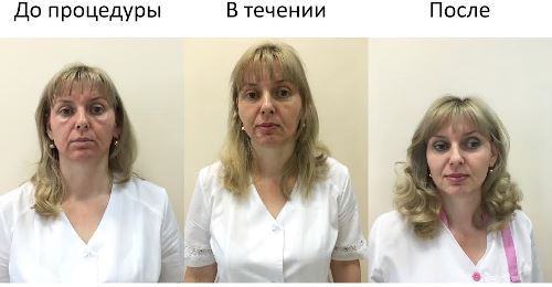 натуральные пилинги, косметология в Иркутске, лечение акне, антивозрастные пилинги