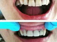 реставрация зубов, стоматолог Иркутск, уход за зубами