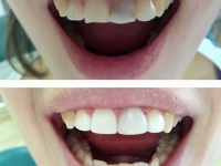 реставрация зубов, стоматолог Иркутск, уход за зубами